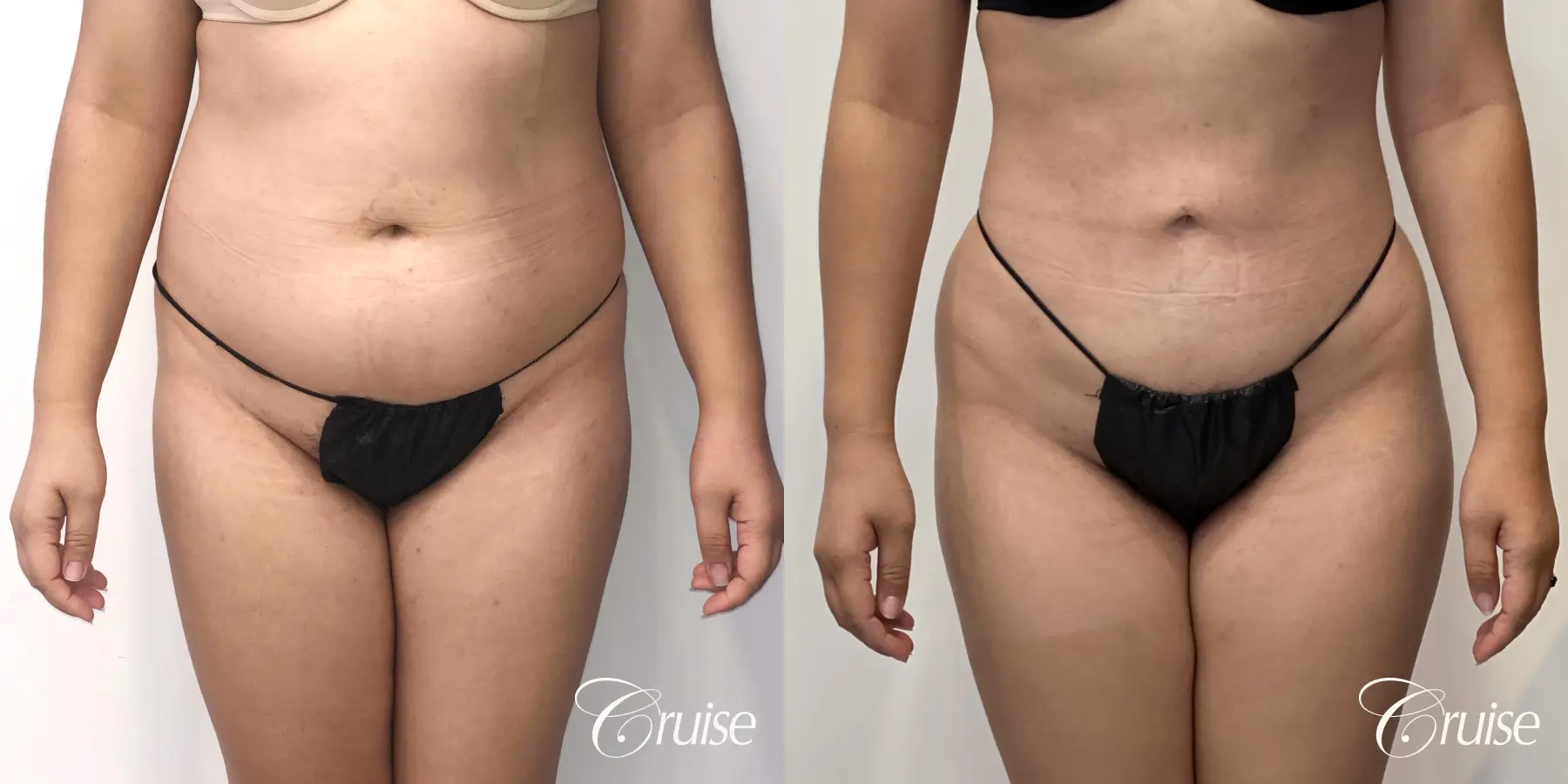 Liposuction: Patient 54 - Before and After 1