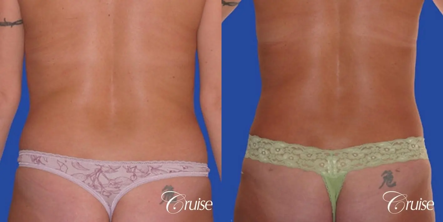liposuction abdomen flanks with tummy tuck - Before and After 1