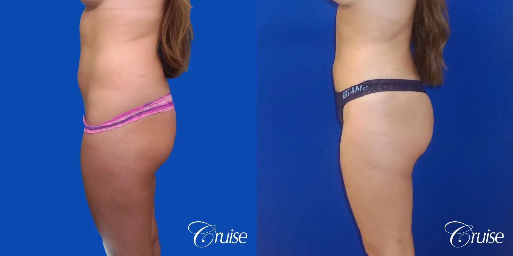 Liposuction - Before and After 2