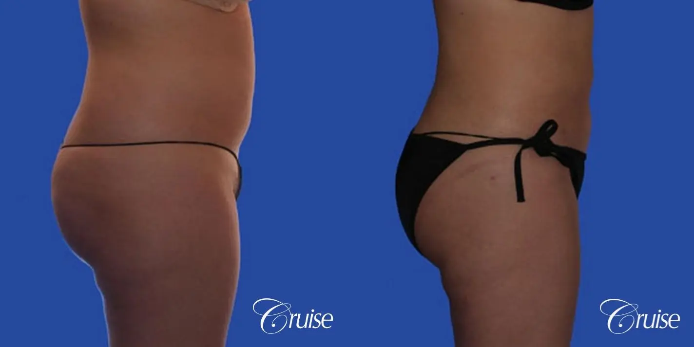 best pictures of liposuction with plastic surgeon in Newport Beach - Before and After 5