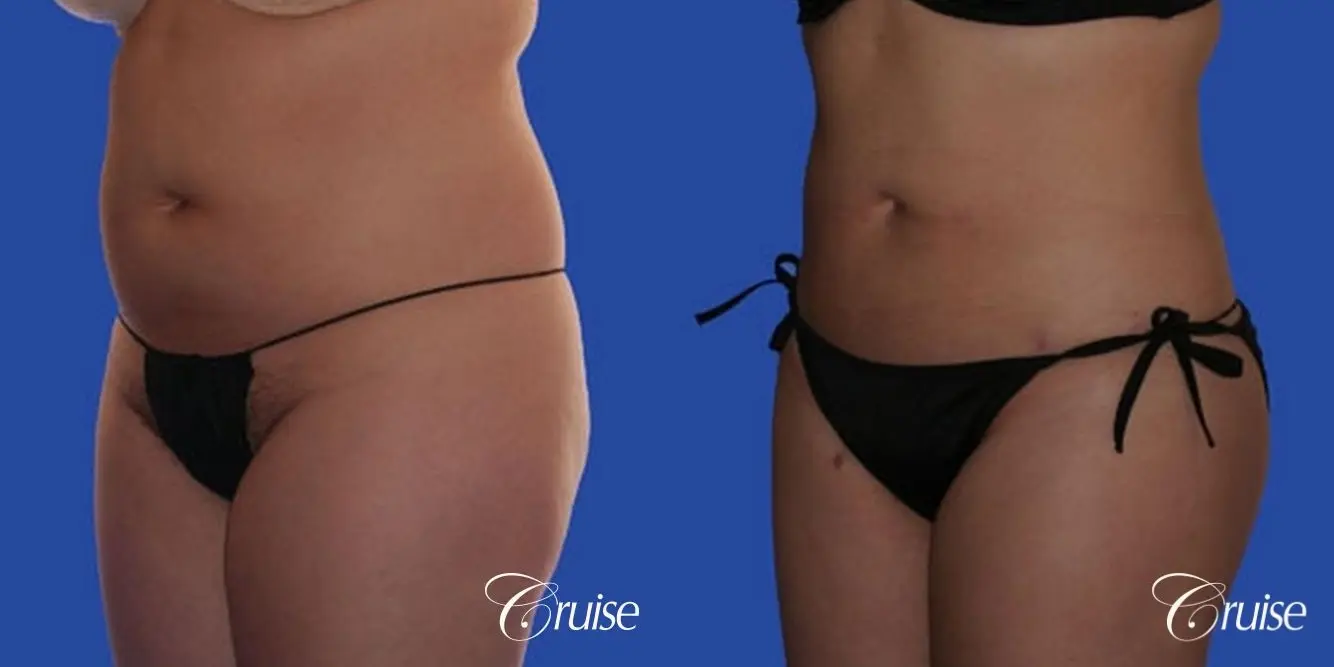 best full body liposuction abdomen flanks thighs knees - Before and After 2