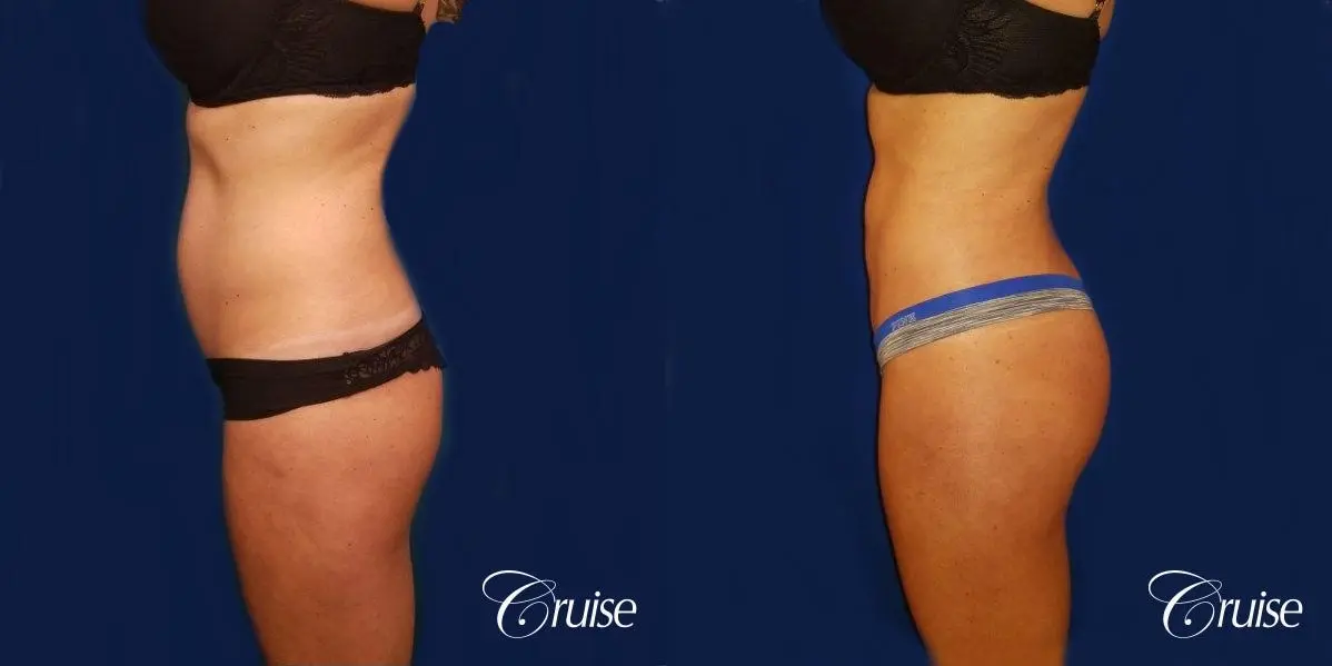 Brazilian Butt Lift Dr. Cruise - Before and After 2