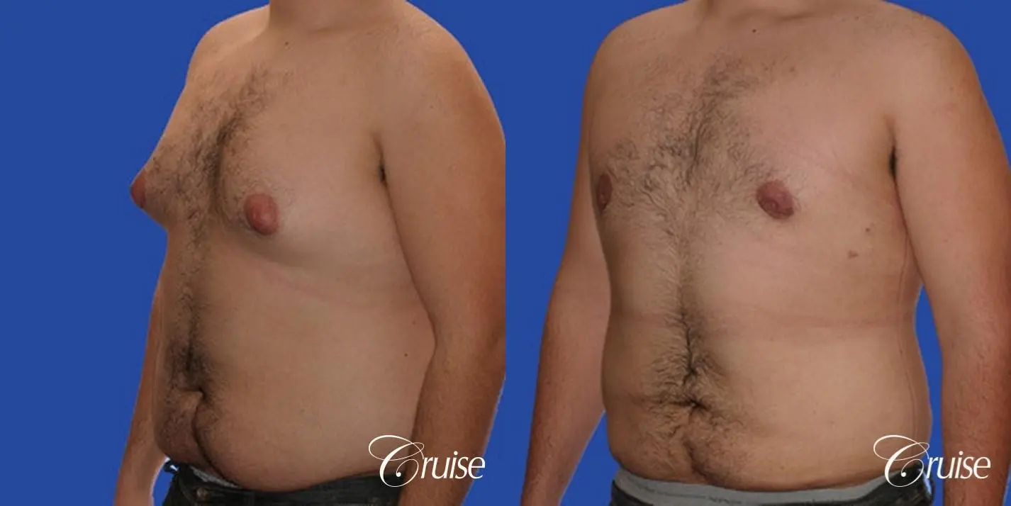 male liposuction abdomen flanks with Gynecomastia - Before and After 3