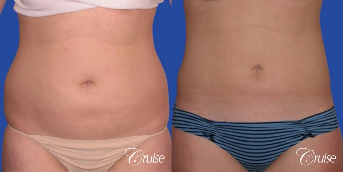 best skinny abs from liposuction abdomen and flanks - Before and After 1