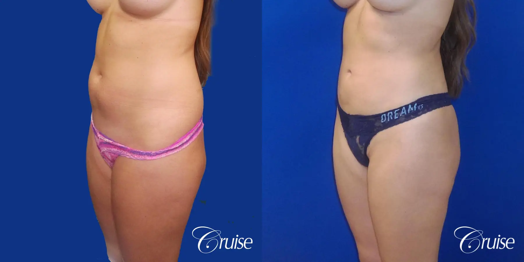 Liposuction - Before and After 3