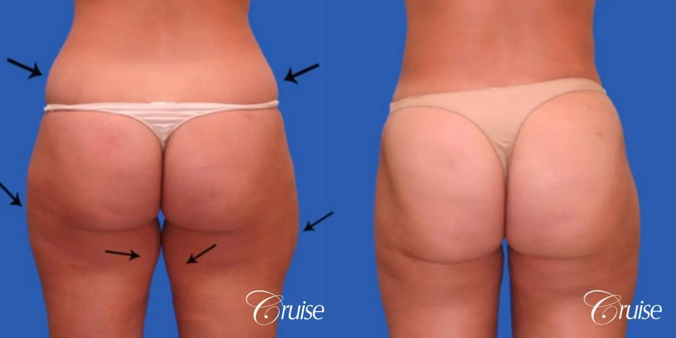 best liposuction abdomen flanks medial and lateral thighs dramatic - Before and After 3