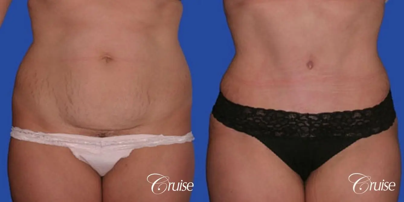 best dramatic flank liposuction pictures - Before and After 1