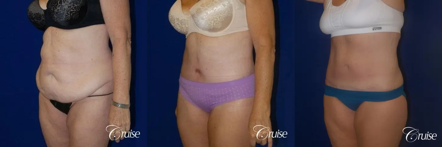 Liposuction with Circumferential Tummy Tuck w/BBL & Liposuction - Before and After 4