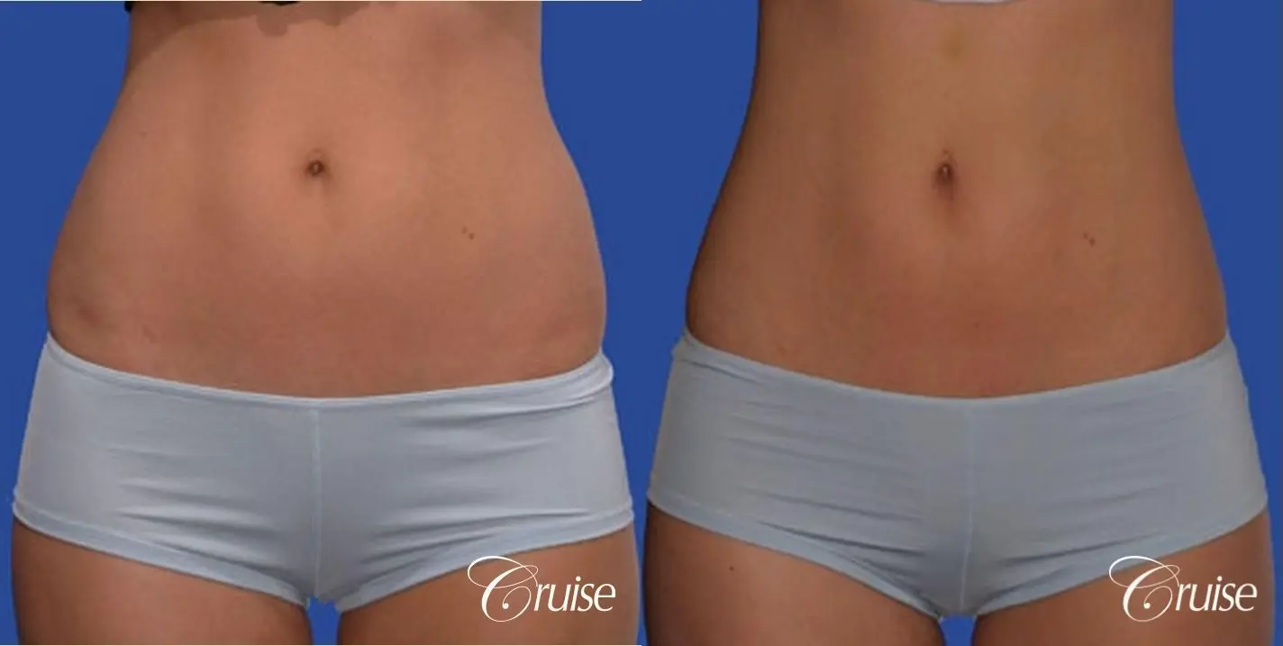 Abs & Waist Liposuction Before & After