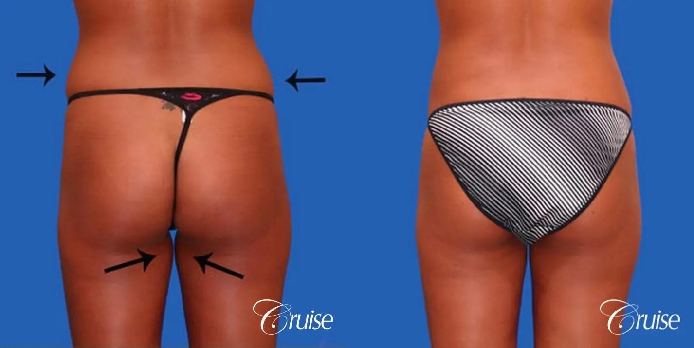 best liposuction abdomen and love handles - Before and After 3