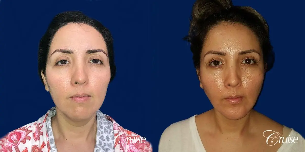 Liposuction of Neck/Jawline - Before and After  