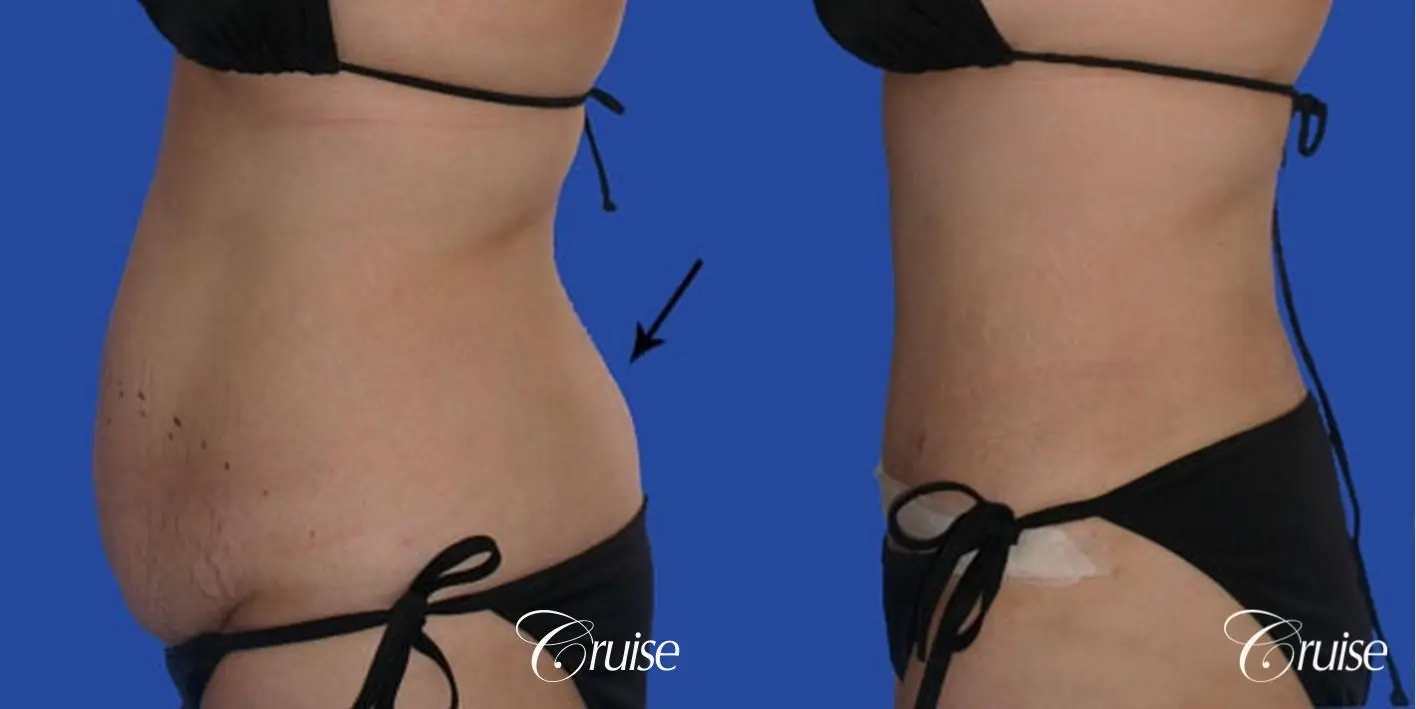 best liposuction tummy tuck - Before and After 2
