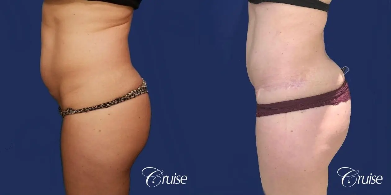 Liposuction - Before and After 2