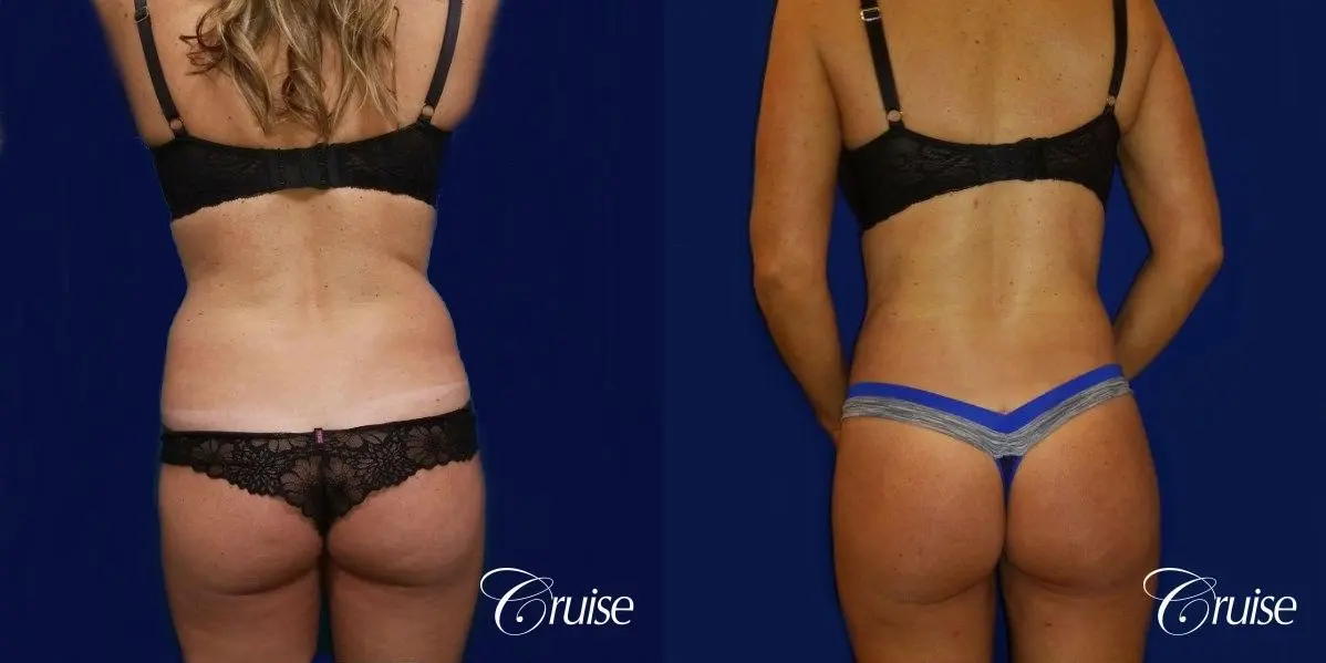 Brazilian Butt Lift Dr. Cruise - Before and After