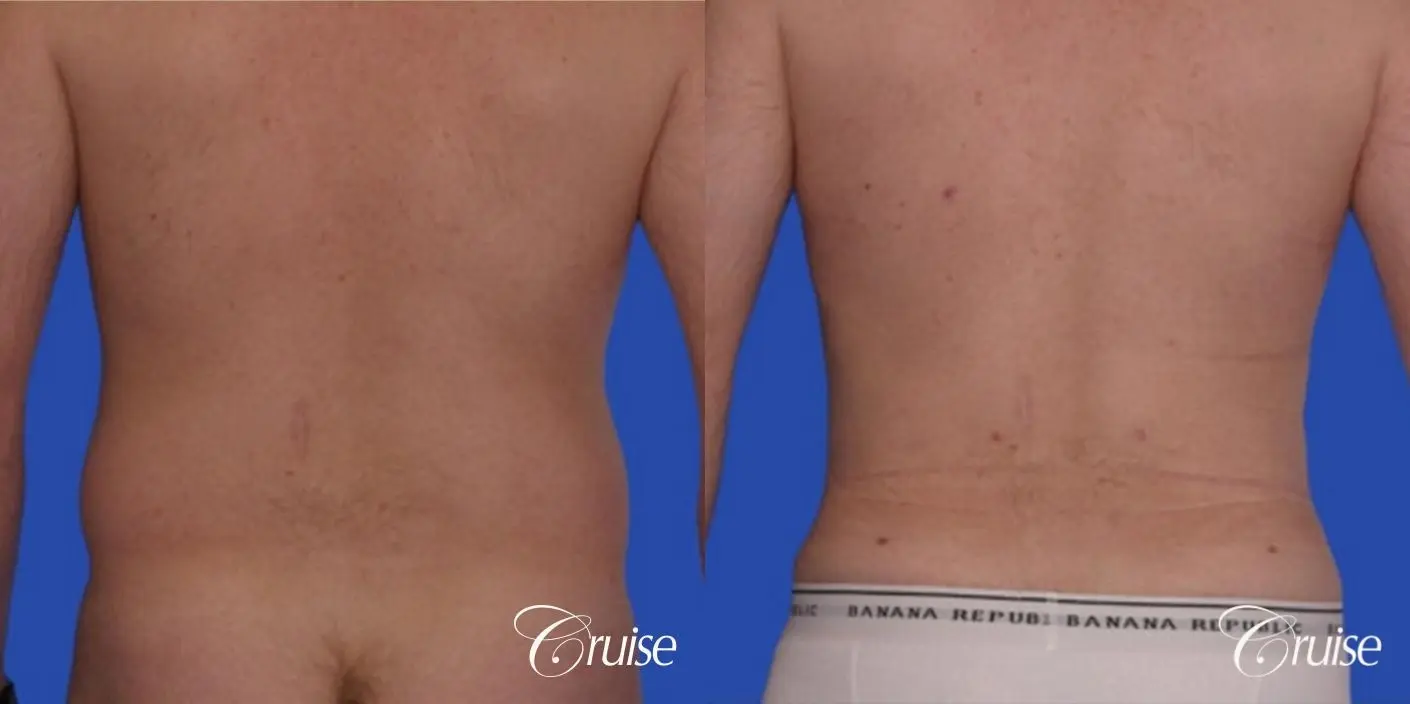 Male Flanks Liposuction - KleinLipo - Liposuction Surgery of Orange County