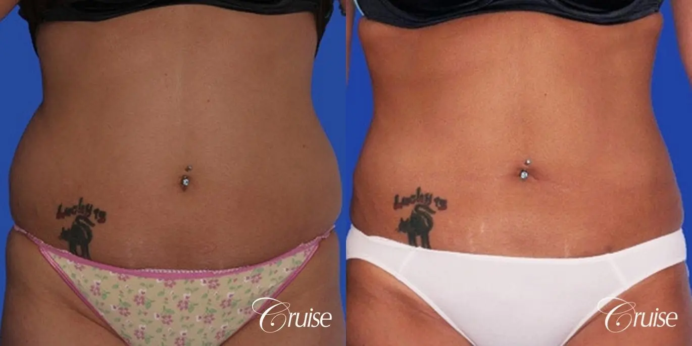 pictures of tummy lipo and lipo muffin top - Before and After 1
