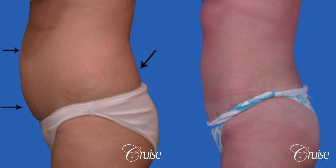 liposuction on abdomen photos - Before and After 2