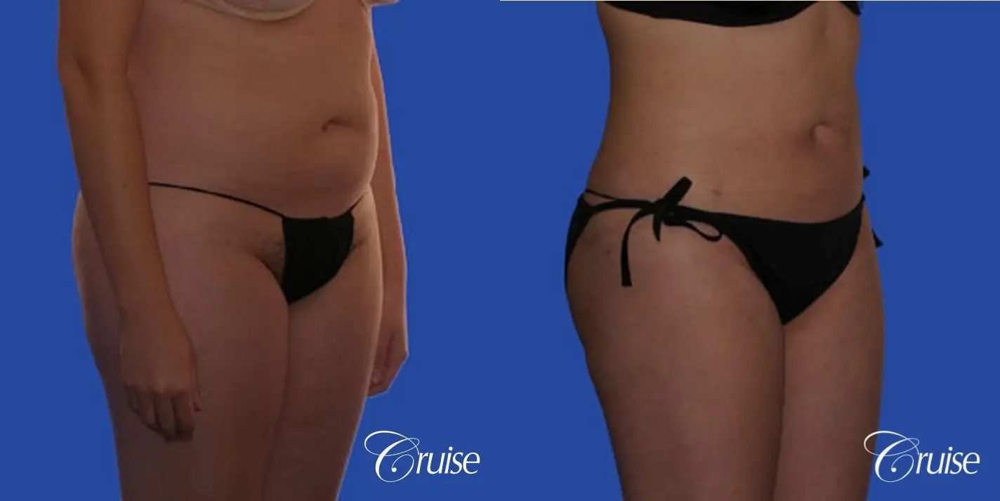 best pictures of liposuction with plastic surgeon in Newport Beach - Before and After 4