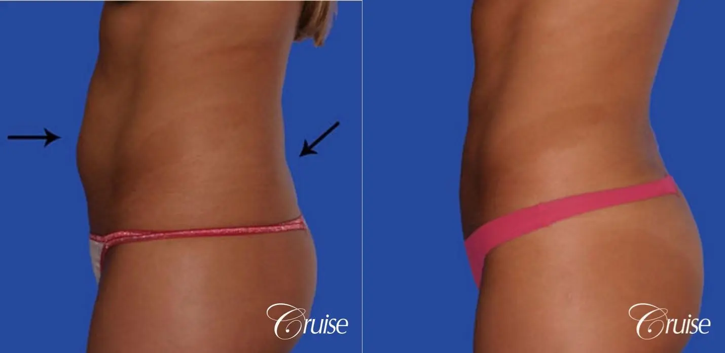 Liposuction of the 'love handles' or flanks