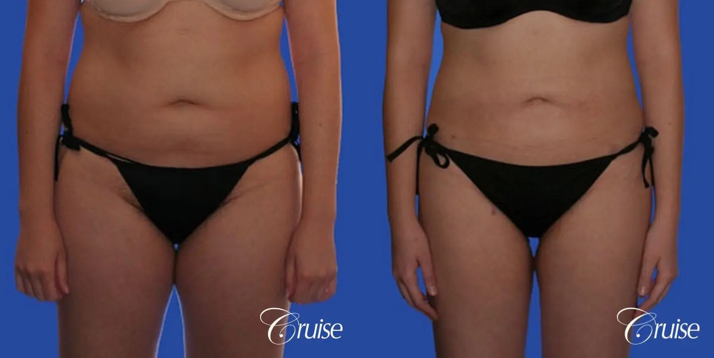 best full body liposuction abdomen flanks thighs knees - Before and After 1