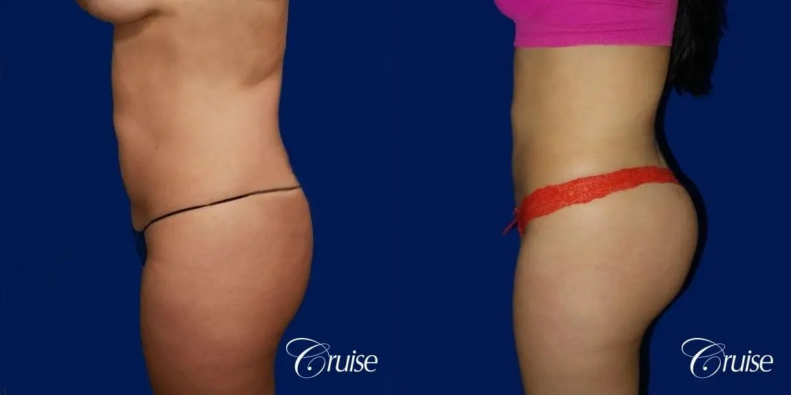 Liposuction - Before and After 1