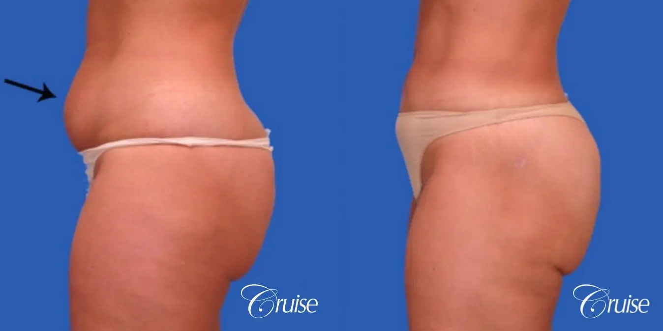 best liposuction abdomen flanks medial and lateral thighs dramatic - Before and After 2