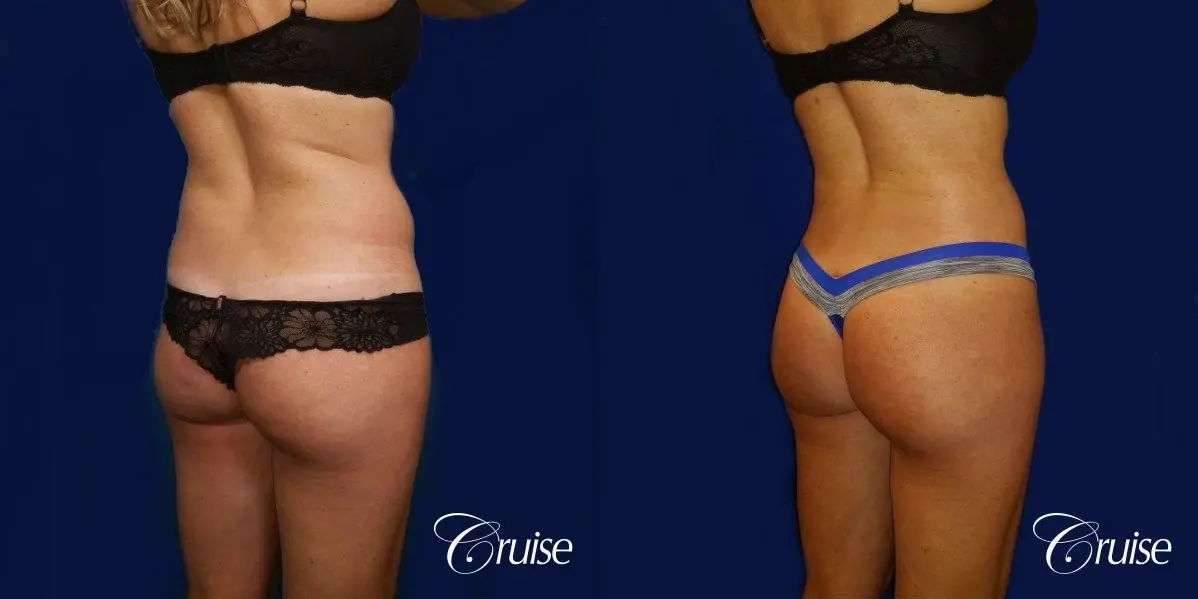 Brazilian Butt Lift Dr. Cruise - Before and After 4
