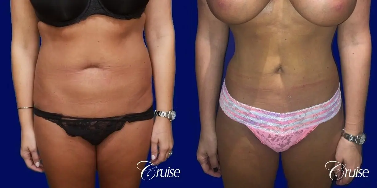 Liposuction Abdomen and Flanks with Midline Contour - Before and After  