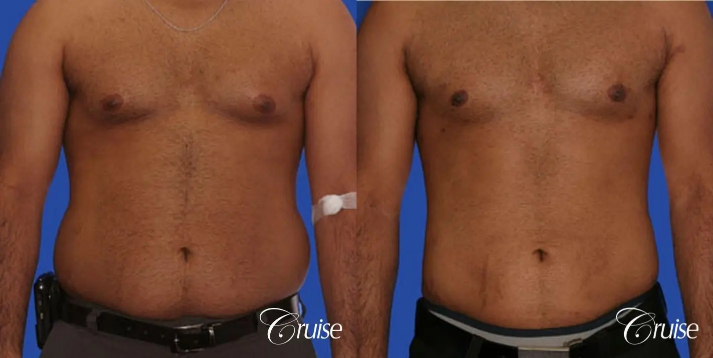 best liposuction abdomen and flanks on a male patient - Before and After 1