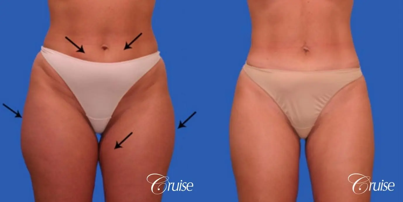 best liposuction abdomen flanks medial and lateral thighs dramatic - Before and After 1