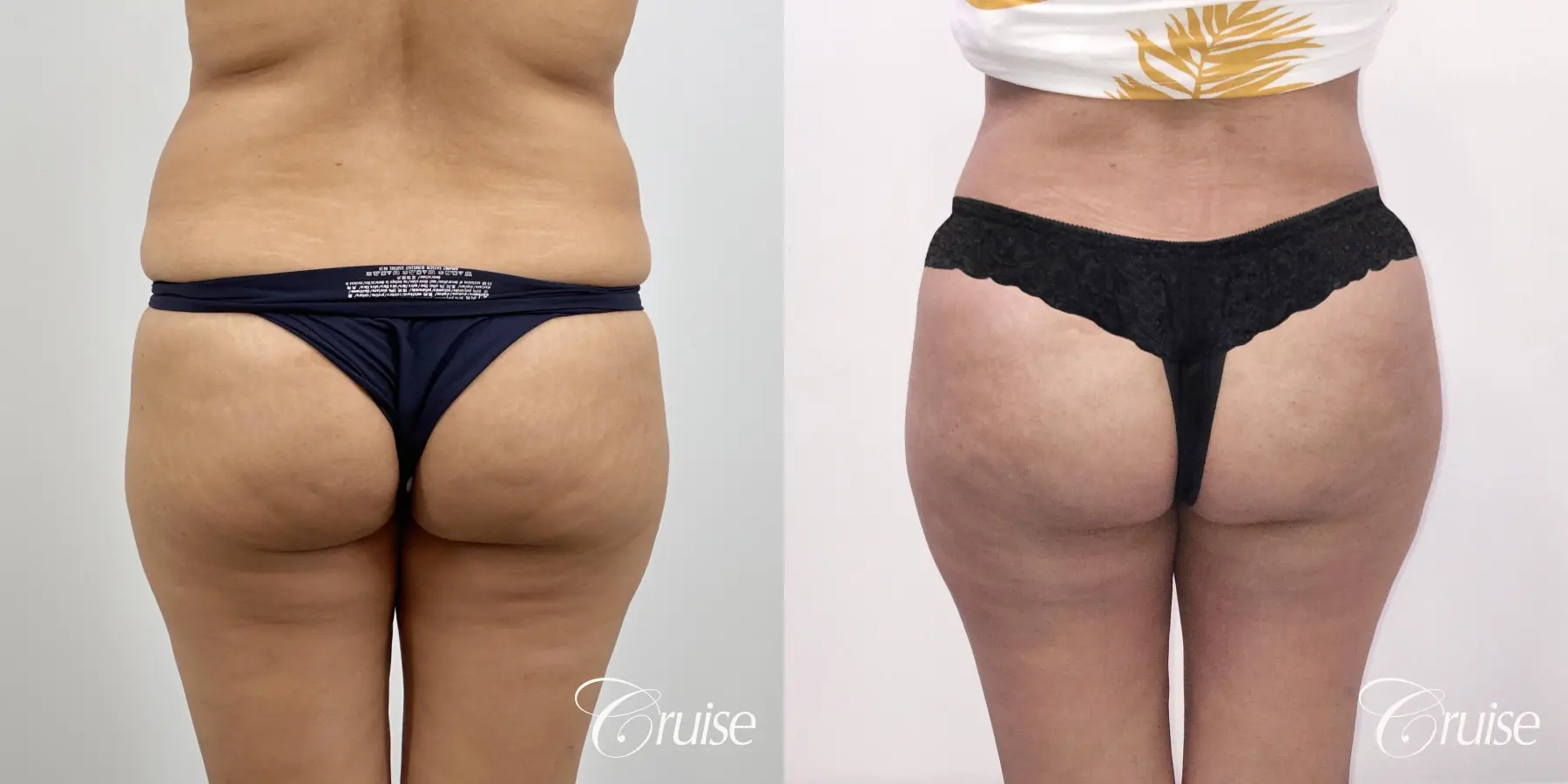 Liposuction - Before and After 1