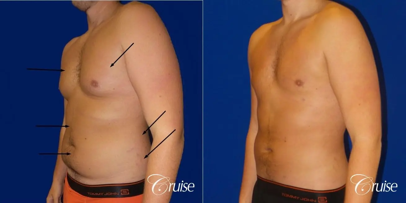 Best  before and after lipo photos of guys - Before and After 2