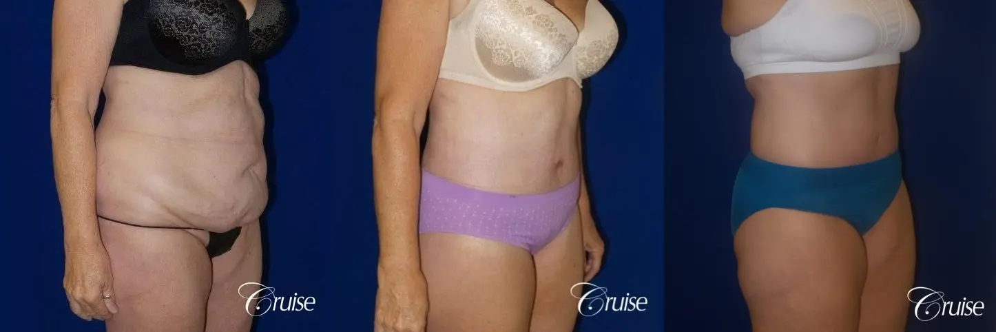 Liposuction with Circumferential Tummy Tuck w/BBL & Liposuction - Before and After 2