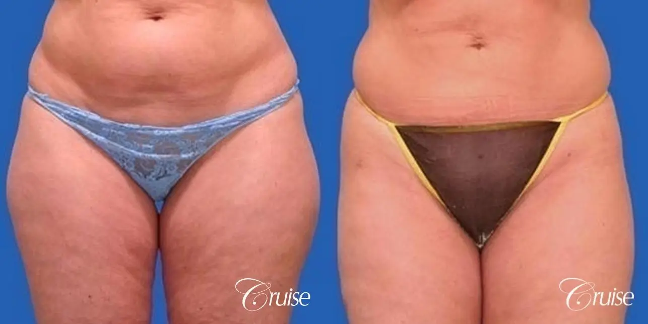 best liposuction abdomen, flanks and thighs - Before and After 1