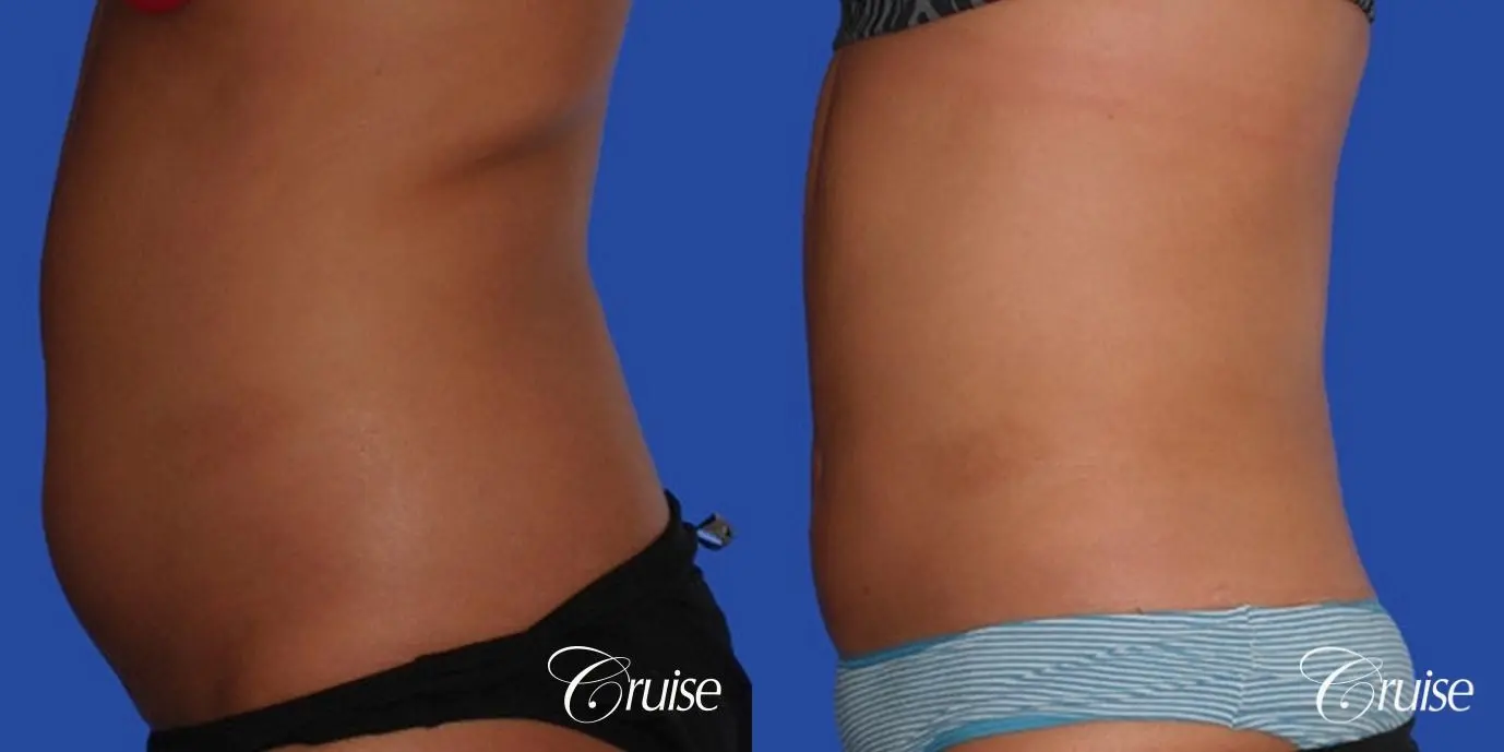 fast way to get with of love handles with liposuction flanks - Before and After 2