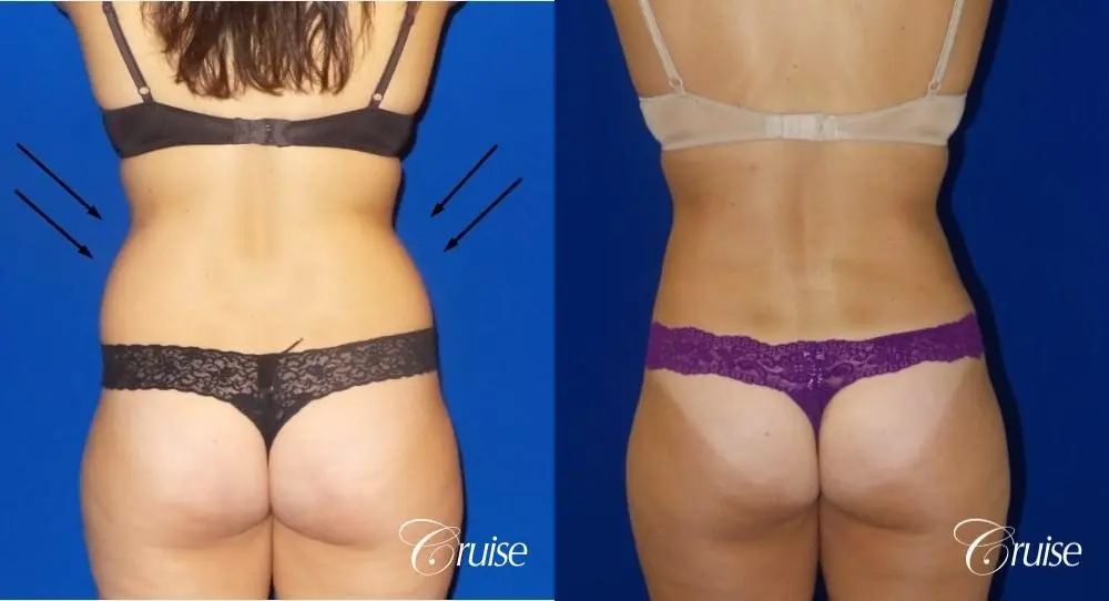 Liposuction -  Flanks - Before and After 3