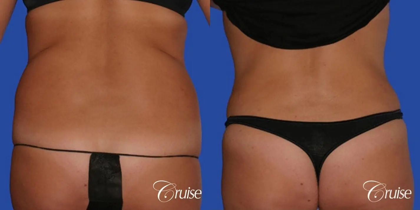 pictures of love handle liposuction - Before and After 1