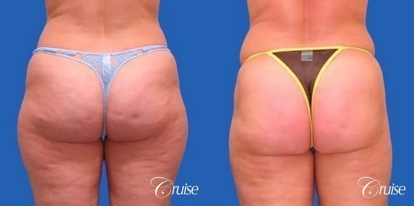 best liposuction abdomen, flanks and thighs - Before and After 3