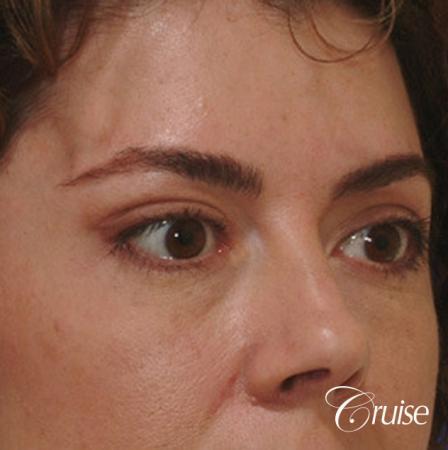 blepharoplasty specialist - After Image 3