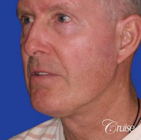 62 year old with chin implant and neck lift - After Image 2
