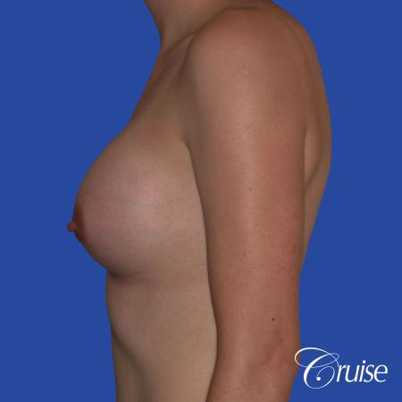 Breast Augmentation - After Image 2