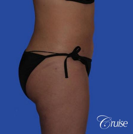 best pictures of liposuction with plastic surgeon in Newport Beach - After Image 5