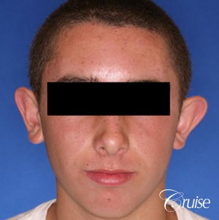 teen boy gets otoplasty in Newport beach - Before Image 1