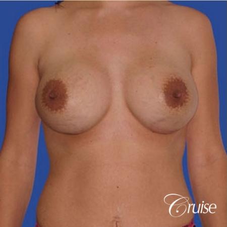 mini tummy tuck with silicone breast revision - After Image 1