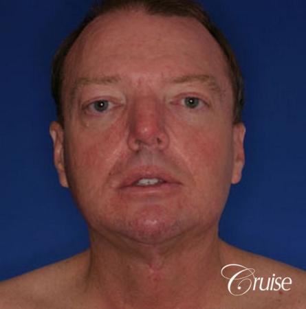 best male chin implant with large square jaw - After Image 1