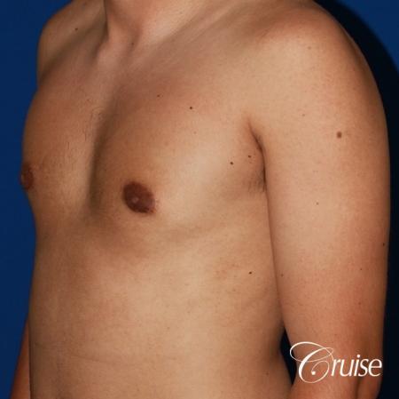 mild gynecomastia before and after with puffy nipple - After Image 3