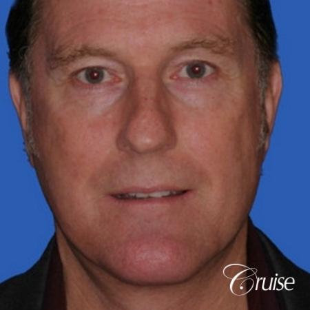 52 yr old male with medium square chin implant - After Image 1