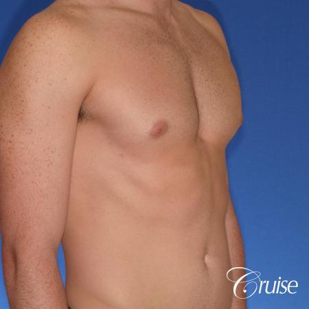 body builder with puffy nipples gets gyne surgery - After Image 3