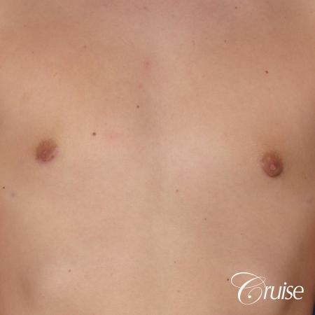teen with pointy / puffy nipples get gynecomastia surgery - After Image 4