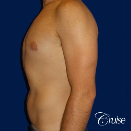 Type 2 Gynecomastia Glandular Removal - After Image 3